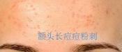 額頭長痘，臉頰長痘痘粉刺，就這樣恢復(fù)嫩白肌膚！