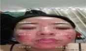【祛痘視頻反饋】激素臉長痘20多年，大膿包，發(fā)癢，完全恢復(fù)！